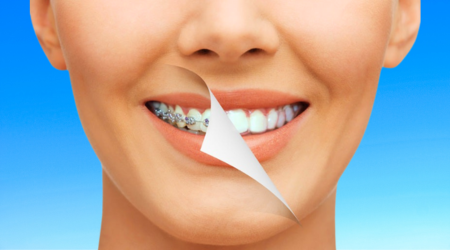 Teeth straightening | Compare options, costs and treatment times